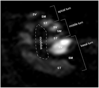 High-Molecular-Weight Hyaluronic Acid Vehicle Can Deliver Gadolinium Into the Cochlea at a Higher Concentration for a Longer Duration: A 9.4-T Magnetic Resonance Imaging Study